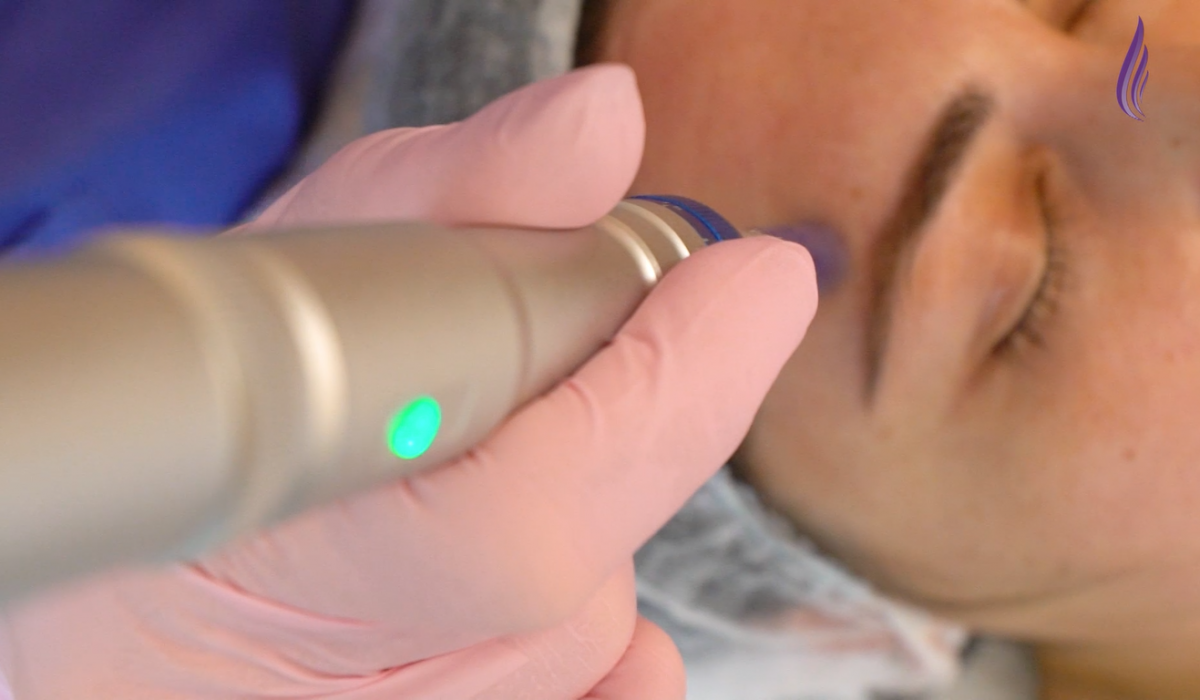 Microneedling, un must have in portofoliul unei cosmeticiene
