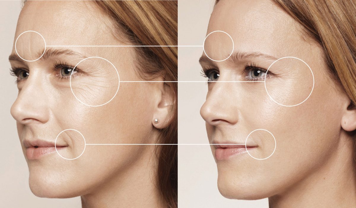 SKIN BOOSTER: terapia care nu te lasa sa imbatranesti