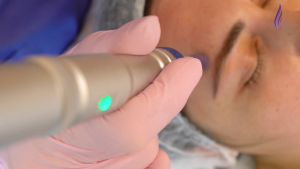 Microneedling