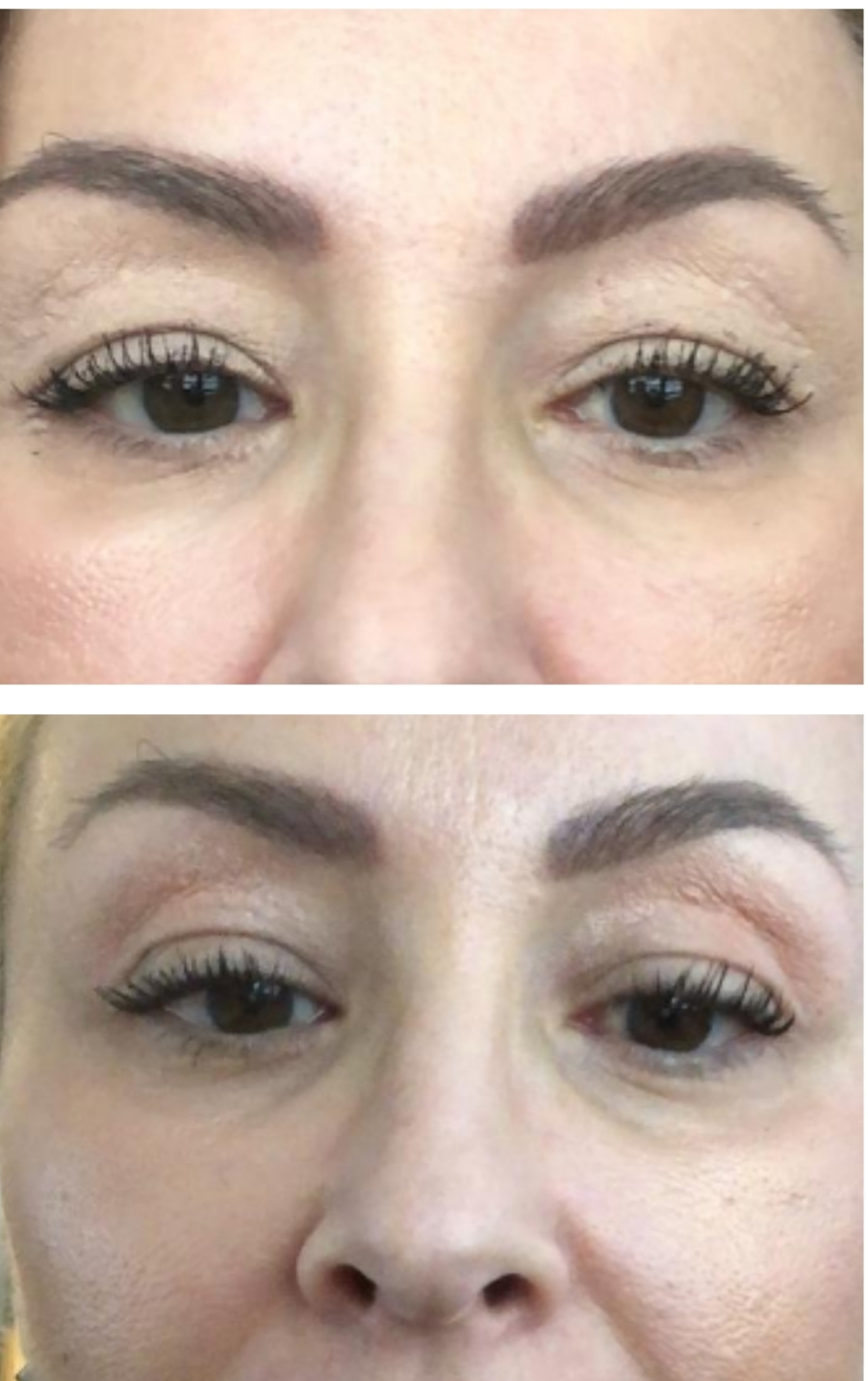 Before After Plasma Pen
