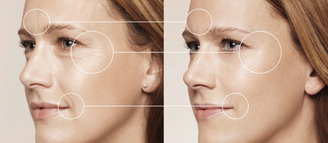 efect-restylane-skin-boosters